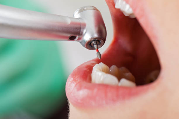 Best Emergency Treatment for Dental Infections or Abscesses in Sylva, NC